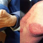 leprosy-hansens-disease-in-florida-a-comprehensive-overview