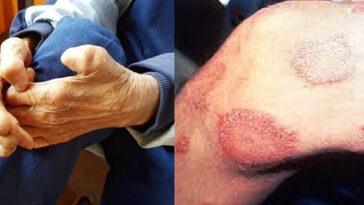 leprosy-hansens-disease-in-florida-a-comprehensive-overview