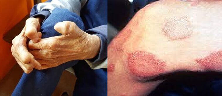 leprosy-hansens-disease-in-florida-a-comprehensive-overview