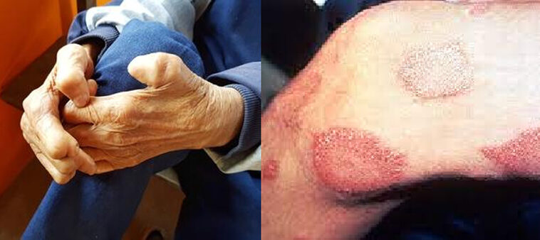 leprosy-hansens-disease-in-florida-a-comprehensive-overview